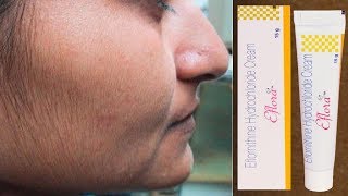 Eflora Cream for Facial Hair Removal  Eflora cream uses in Hindi [upl. by Ynettirb375]