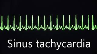 Sinus rhythm bradycardia and tachycardia [upl. by Namruht990]