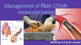 Management of Non STEMI Timing for PCI Anticoagulation antiplatelet UN VS NSTEMI [upl. by Giliana]