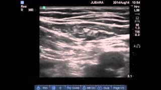 genitofemoral nerve block [upl. by Attolrac]