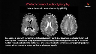 Metachromatic Leukodystrophy  USMLE Biochemistry webinar Case based lecture [upl. by Jacey]