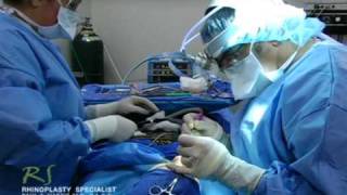 OR Video Footage Turbinoplasty for Revision Rhinoplasty [upl. by Koa712]