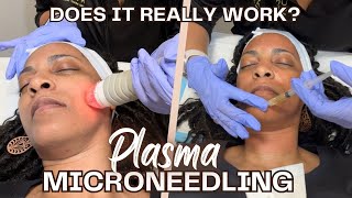 Full Process of my PRP Microneedling for the 1st Time  Will it work [upl. by Rexanne]