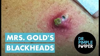 Mrs Golds Back Blackhead Extraction Session  Addressing the Inflamed One [upl. by Kcirddet870]