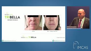 IMCAS Presentation with Dr Neil Sadick on TriBella™ [upl. by Kcirevam]