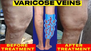 VARICOSE VEINS  PART  I  Before and after Homoeopathy treatment [upl. by Aylsworth]