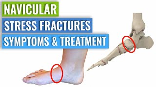 Navicular Stress Fracture Symptoms amp Treatment [upl. by Nidak393]