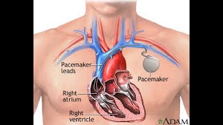 Now powered by Pacemaker  A health update [upl. by Hnahc]