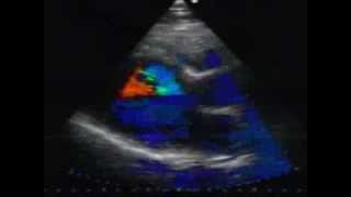 Hypertrophic cardiomyopathy echo case by dr Chatziathanasiou [upl. by Enileoj]