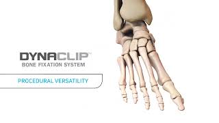 DynaClip® Bone Fixation System Animation [upl. by Moseley]