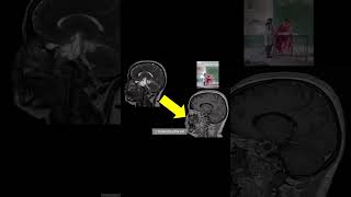 DOLENC approach for cavernous sinus lesion talk at Skull base meeting New Delhi Dr Anil kothiwala [upl. by Zug250]