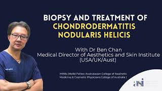 Biopsy and Treatment of Chondrodermatitis Nodularis Helicis [upl. by Aissat267]