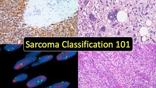 Sarcoma Classification 101 Soft Tissue Tumor Naming Made Simple for Beginners amp NonPathologists [upl. by Gavette747]