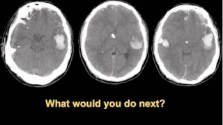 Decompressive Cranium Cases [upl. by Wohlert]