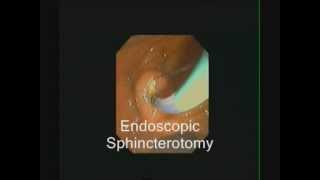 ERCP  Large Sphincterotomy for Large Stones  STEFANOS DOKAS  The ERCP Channel [upl. by Earb]