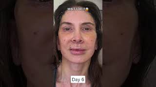 INSANE 2Week Facelift Healing and Recovery Process [upl. by Kcirddes300]