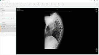 Pedicle Subtraction Osteotomy perform automatically [upl. by Ebneter]