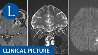 Neurological problems post vaccine against SARSCoV2 [upl. by Nirad]