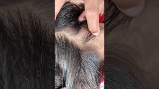 Nit picking asmr headlicetreatment comb hairstyles [upl. by Alleunamme]