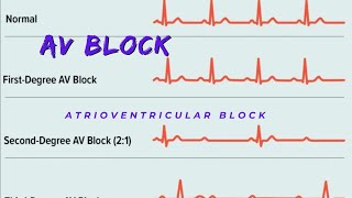 Atrioventricular Block  AV block Causes and Types [upl. by Auqenaj]