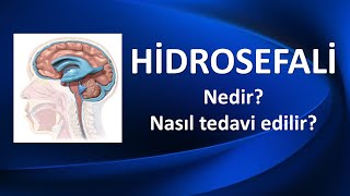 HİDROSEFALİ NEDİR NASIL TEDAVİ EDİLİR [upl. by Julienne]