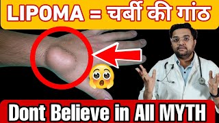 All About Lipoma  What are the causes and treatment options for Lipoma  Lipoma Surgery [upl. by Kela]