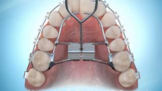 Hyrax Rapid Palatal Expansion Braces During [upl. by Novyart]