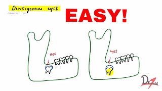 Dentigerous cyst made easy [upl. by Avie]