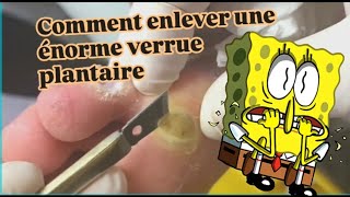 Comment enlever une énorme verrue plantaire [upl. by Nosyrb]