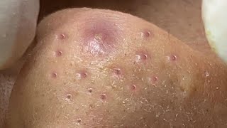 Big Cystic Acne Blackheads Extraction Blackheads amp Milia Whiteheads Removal Pimple Popping  8251 [upl. by Nahallac]