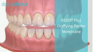 OSSIX PLUS Resorbable Collagen Dental Membrane 2014 [upl. by Hnad]