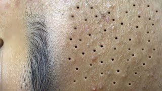 Big Cystic Acne Blackheads Extraction Blackheads amp Milia Whiteheads Removal Pimple Popping  6630 [upl. by Nelyt]