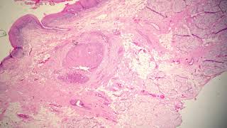 Well Differentiated Squamous Cell Carcinoma Verrucous Type [upl. by Gent]