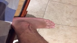 como volver a jugar futbol despues de una lesion fracturas de tobillo en futbol fractura peroné [upl. by Eiramnaej198]