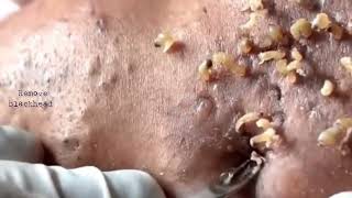 Acne amp Blackhead Treatment on his foreheadBlackhead Removal on forehead  Remove Blackhead [upl. by Nalod]