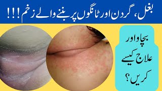 Rash and infection of skin folds  intertrigo treatment and home remedies  Armpit and groin rash [upl. by Ivad]