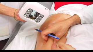 Dr Pierre Courchesne  Traitement de la cellulite  VelaShape [upl. by Anidal]