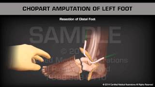 Chopart Amputation Left Foot [upl. by Aroda]