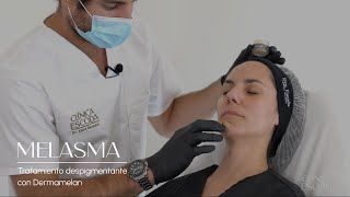 Tratamiento de melasma con Dermamelan [upl. by Rania]