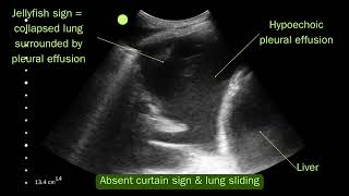 Lung ultrasound  Simple pleural effusion VS hydropneumothorax [upl. by Holms702]