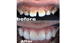 Anterior composite Direct veneerswith rubber dam [upl. by Sacul]