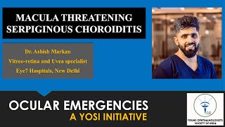 Macula Threatening Serpiginous Choroiditis  Dr Ashish Markan  YOSI Ocular Emergency  Episode 19 [upl. by Coats]