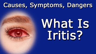 What Is Iritis Causes Symptoms Dangers To Vision Health [upl. by Eizus]