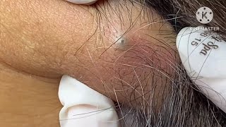 sebaceous cyst behind the neck HoangMySpa78 [upl. by Cadel]