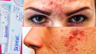 क्या आपको भी Acne or Pimples हो गए हैं  use करिए ये skintel Gel और पाइये acne फ्री चेहरा [upl. by Notniw]