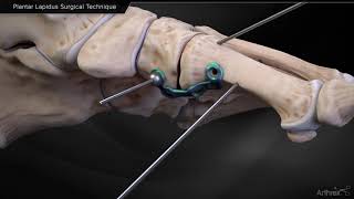 Plantar Lapidus Surgical Technique [upl. by Findlay]