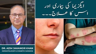 Skin Allergy  Eczema  Chambal Ka Ilaj  Best Treatment in Lahore Islamabad Karachi Pakistan [upl. by Emmie890]