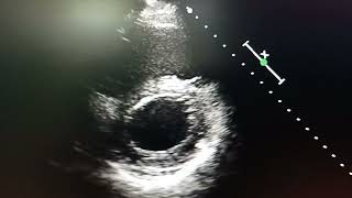 Papillary muscles resection during mitral valve replacement Absent papillary muscles [upl. by Porett247]