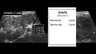 TIRADS 5 Thyroid Nodule with tumor thrombus [upl. by Aicirt]