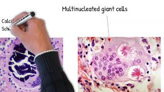 Sarcoidosis easy explained causes mechanism and pathology [upl. by Ravilob]